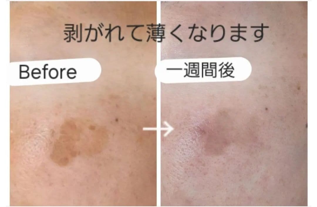 シミとり美顔器■電気美容針/シミとり/導入